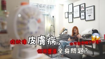 皮膚上的「千面女郎」- 紅斑狼瘡